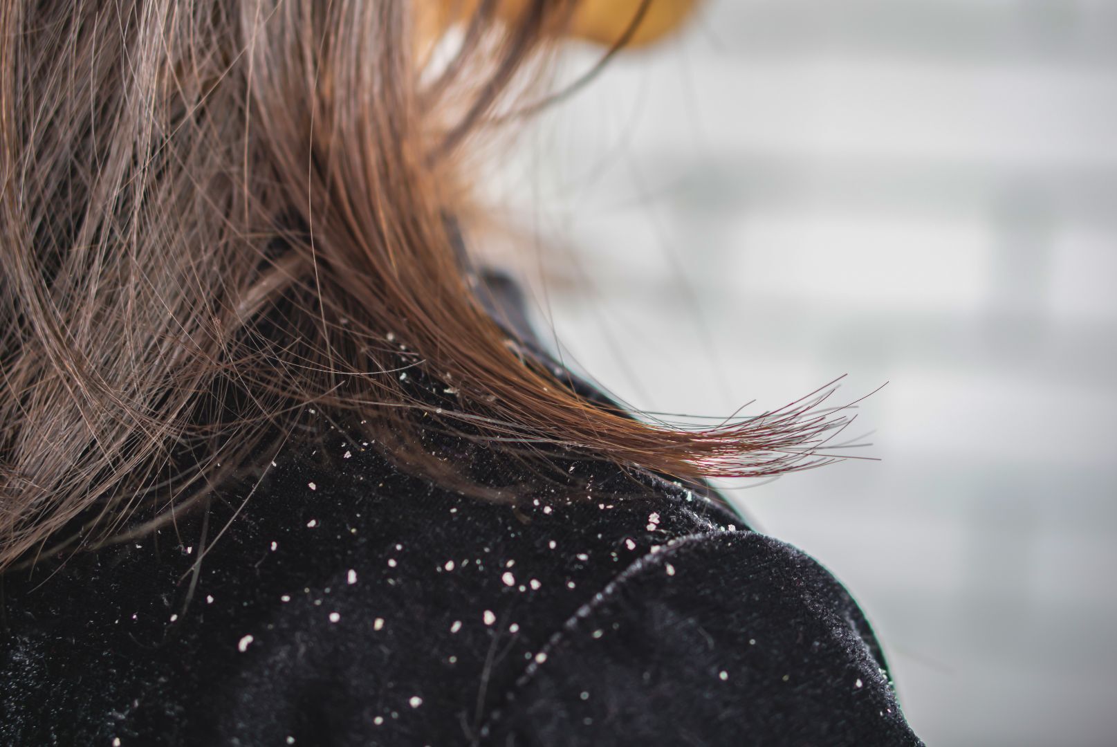 What’s Causing Your Dandruff