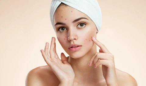 Acne Sufferers: Why You Need To Try Manuka Honey Products