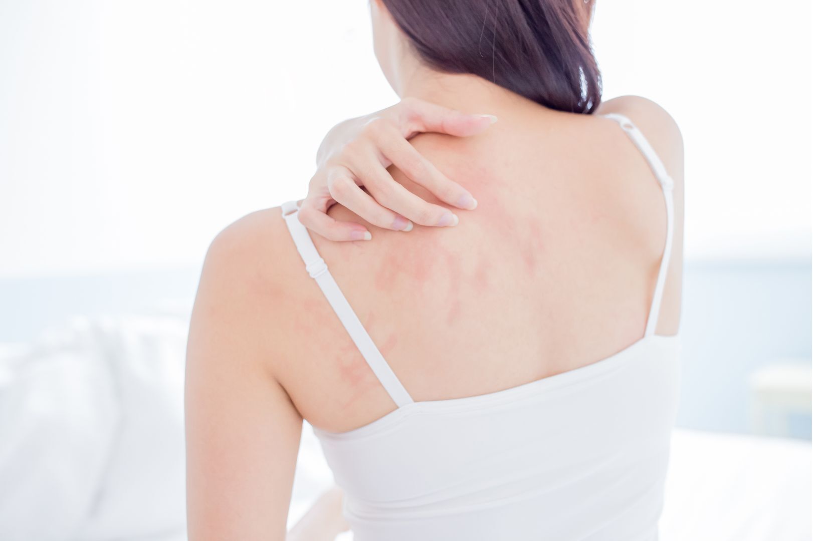 Eczema Or Psoriasis tips