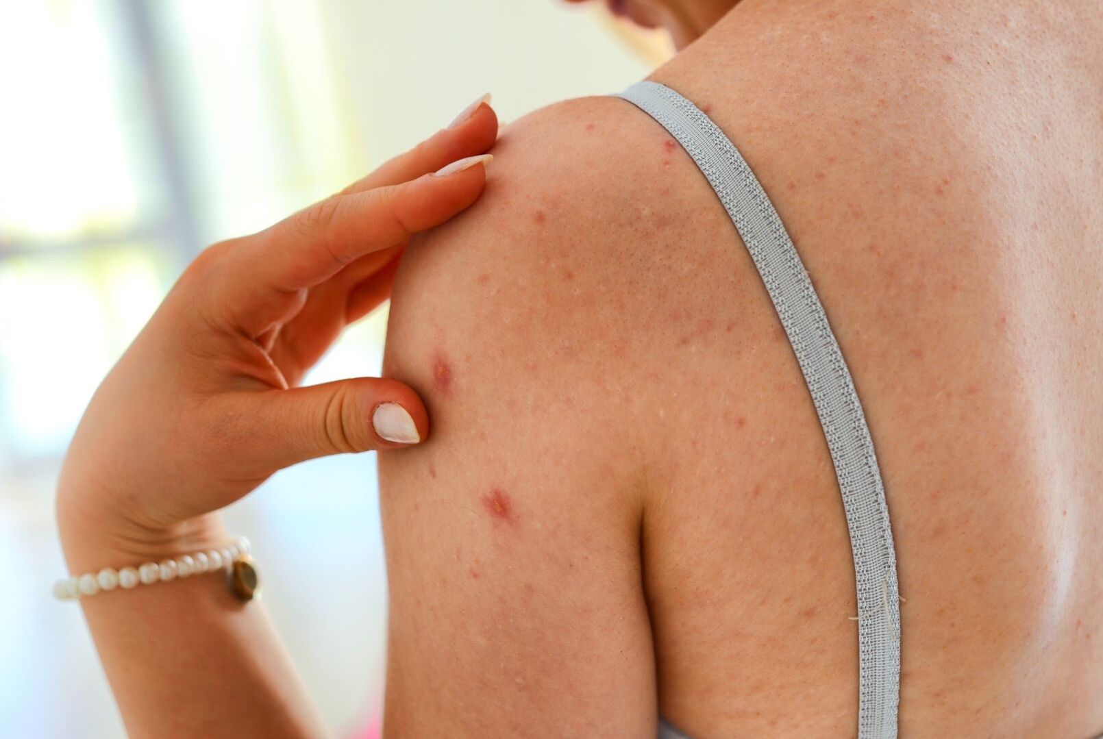 Deciphering Psoriasis vs Eczema & Which One You Have