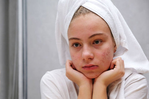 How to treat acne without harsh products