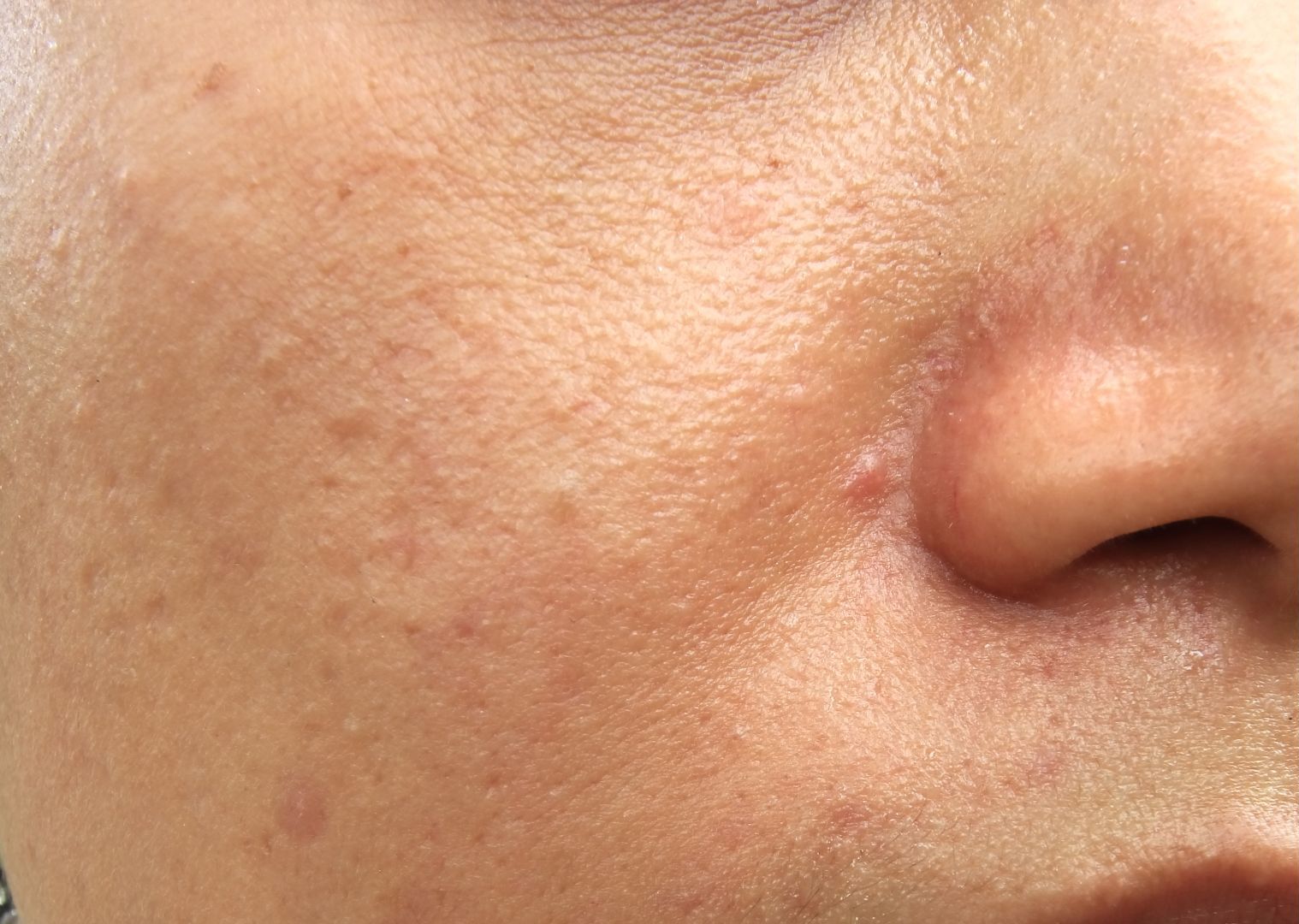 Acne redness