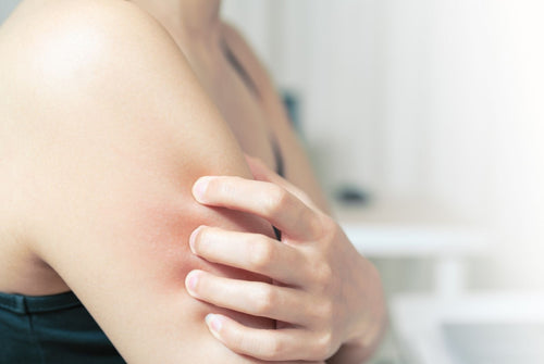 Ways You Can Avoid Eczema Flare Ups