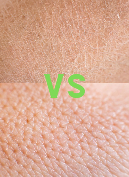 Difference Between Dry Skin Vs Oily Skin