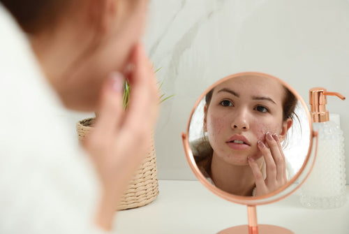 Ways For Fighting Acne