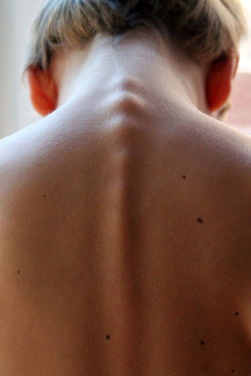 Get Rid Of Back Acne