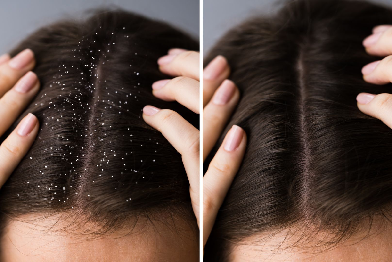 how to remove scalp buildup