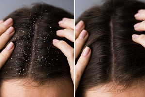 How to Remove Scalp Buildup in 7 Different Ways