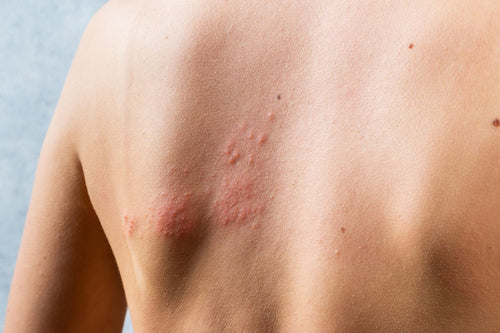Natural Shingles Remedy