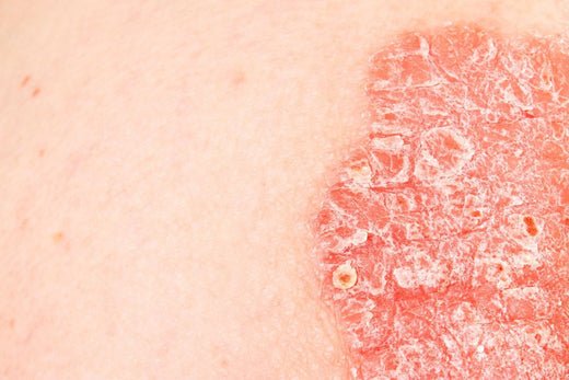 Tackle With Psoriasis