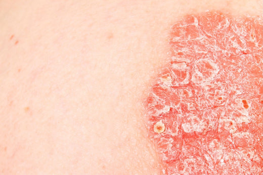 Tackle With Psoriasis