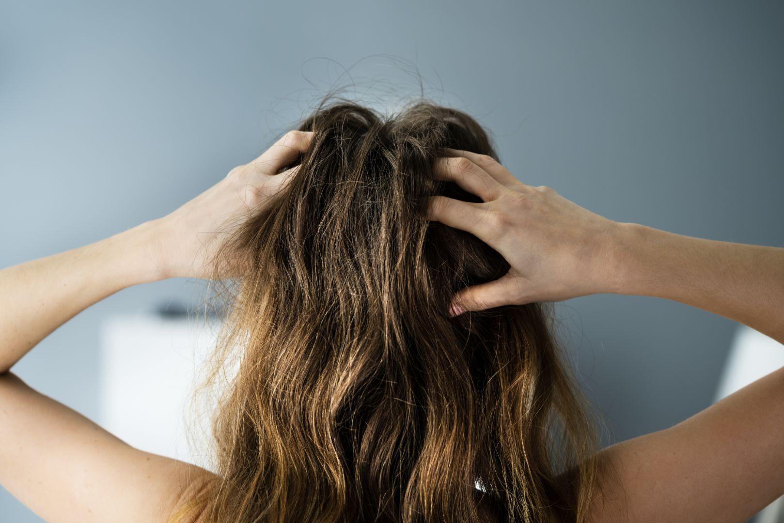 scalp psoriasis