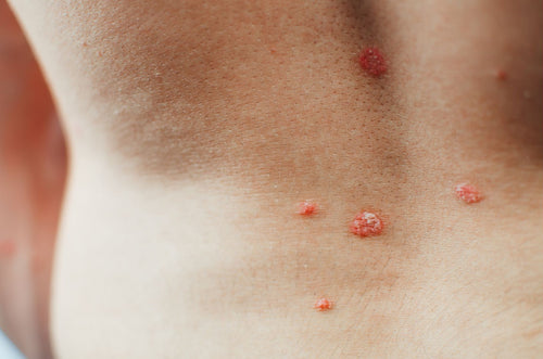 Soap Free For Psoriasis