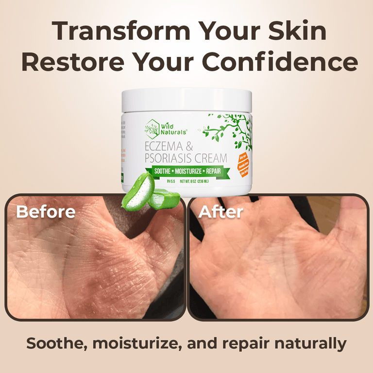 Wild Naturals Eczema & Psoriasis Cream 4 oz jar – natural soothing moisturizer with Manuka honey for dry, itchy, red skin relief.