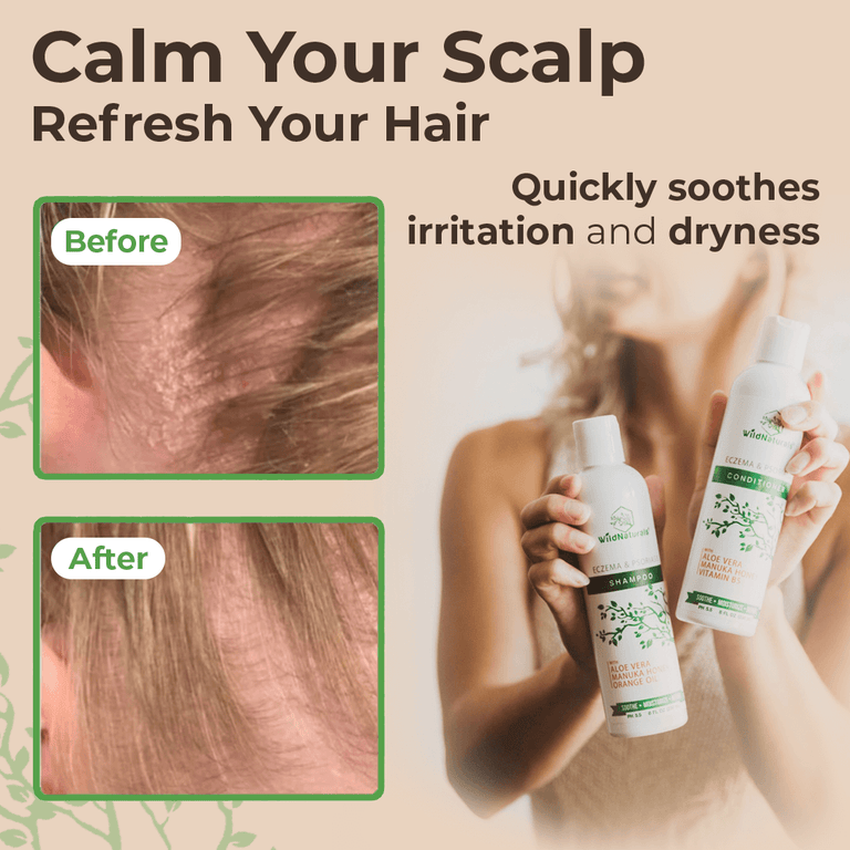 Wild Naturals eczema and psoriasis care bundle with shampoo, conditioner, body wash and cream infused with aloe vera and Manuka honey for sensitive skin relief.